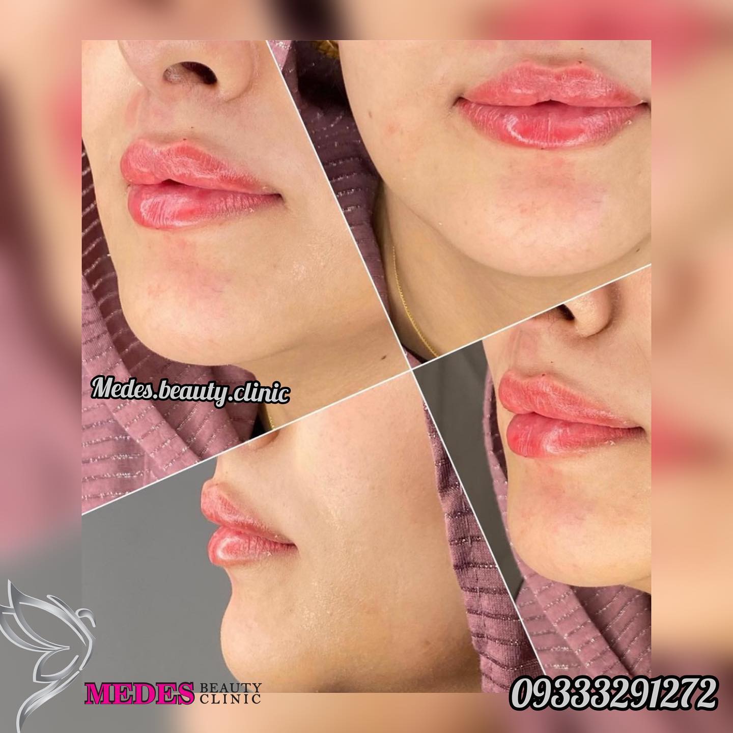 گالری تزریق ژل لب